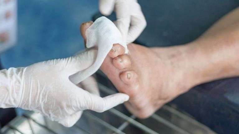 İyileşmeyen ayak yaraları tedavisi