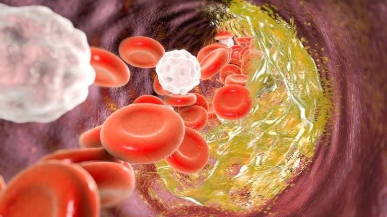 Damarlarda Plak Oluşumu ve Önleme Yöntemleri