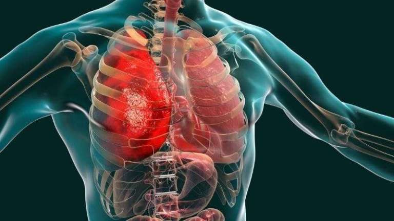 Akciğer Embolisi (Pulmoner emboli) tedavisi